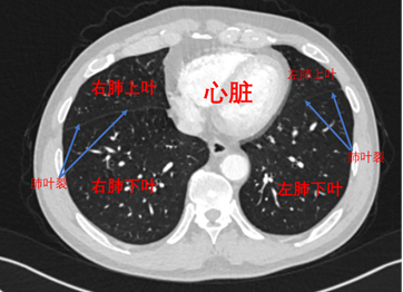 如何用手机拍摄高清肺结节ct照片