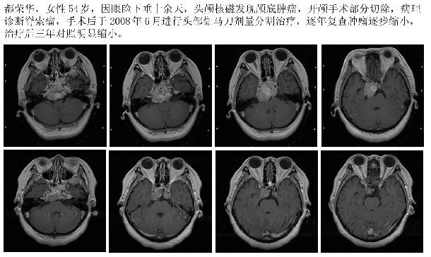 通俗讲解伽玛刀原理