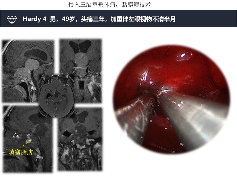 镜无止境 鞍上巨大垂体瘤,颅咽管瘤的内镜微创治疗