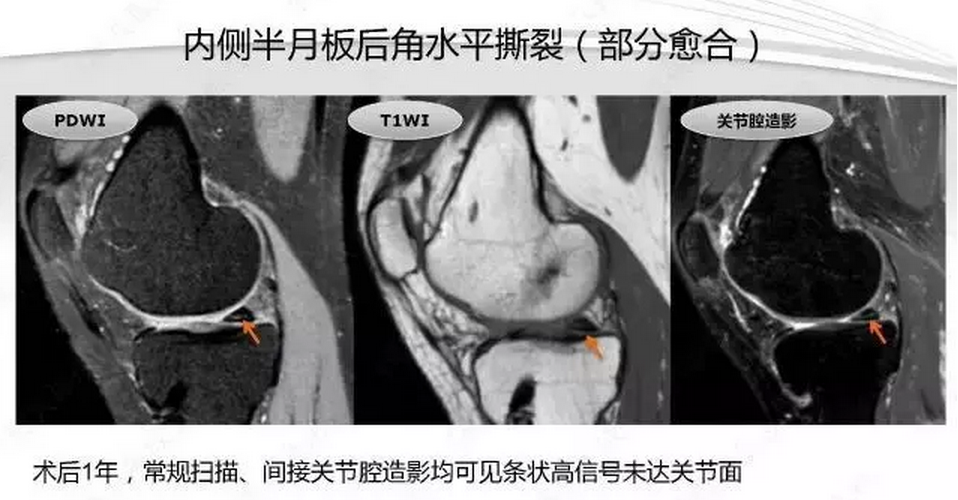 【半月板】半月板损伤的mri诊断