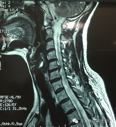 神经根型颈椎病@后路锁孔显微微创椎板-椎