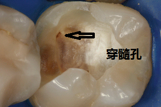 我不随意给患者做根管治疗