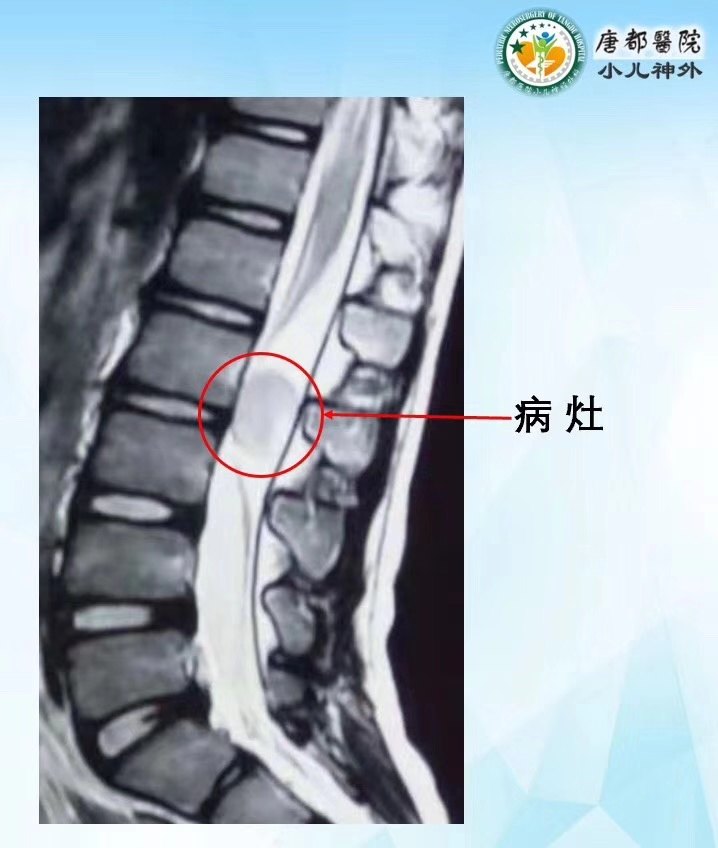 腰2椎管内表皮样囊肿