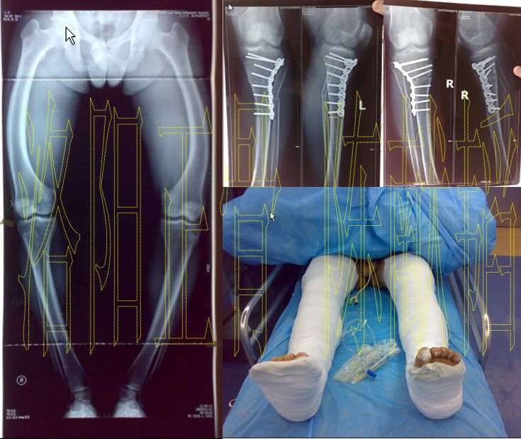 左图为术前双下肢全长片,右侧分别为术后x线片,双下肢外观图.