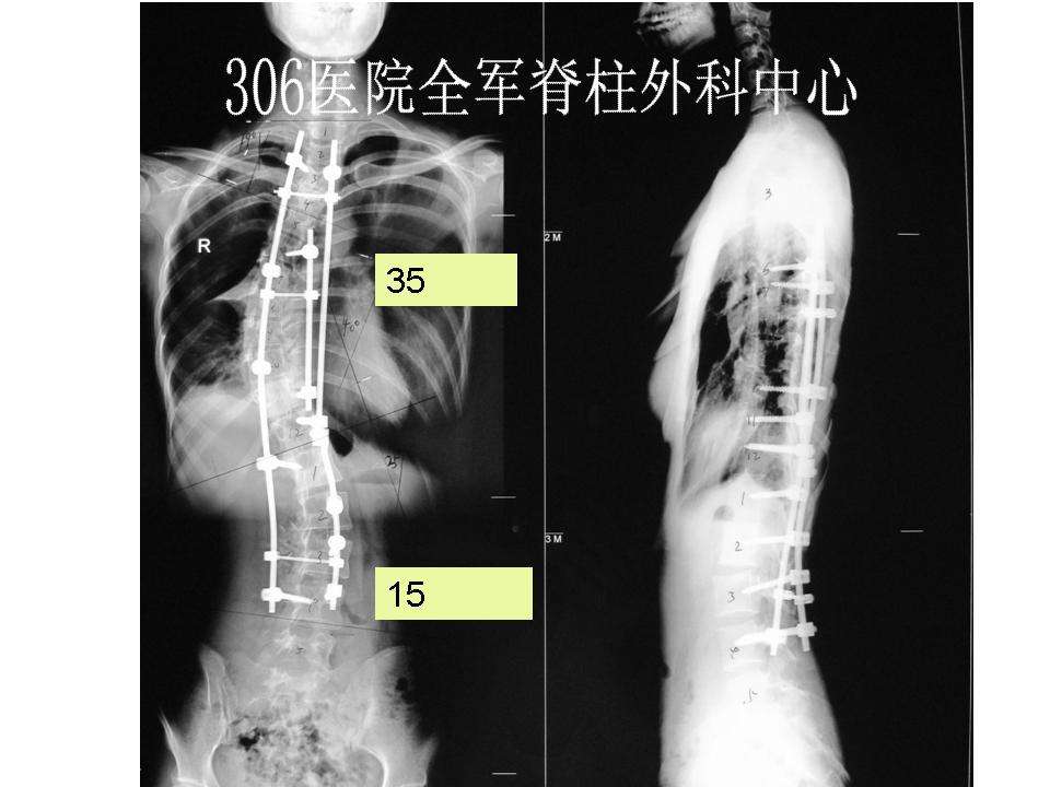 第11例脊柱侧弯典型病例女16岁脊柱侧弯翻修手术