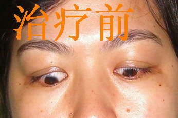 重症甲亢突眼怎么治疗?突眼典型病例治疗前后照片对照