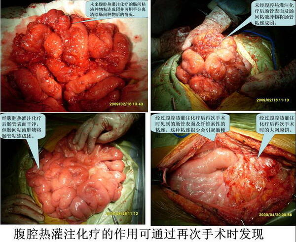 腹膜假性粘液瘤腔镜下及手术中所见