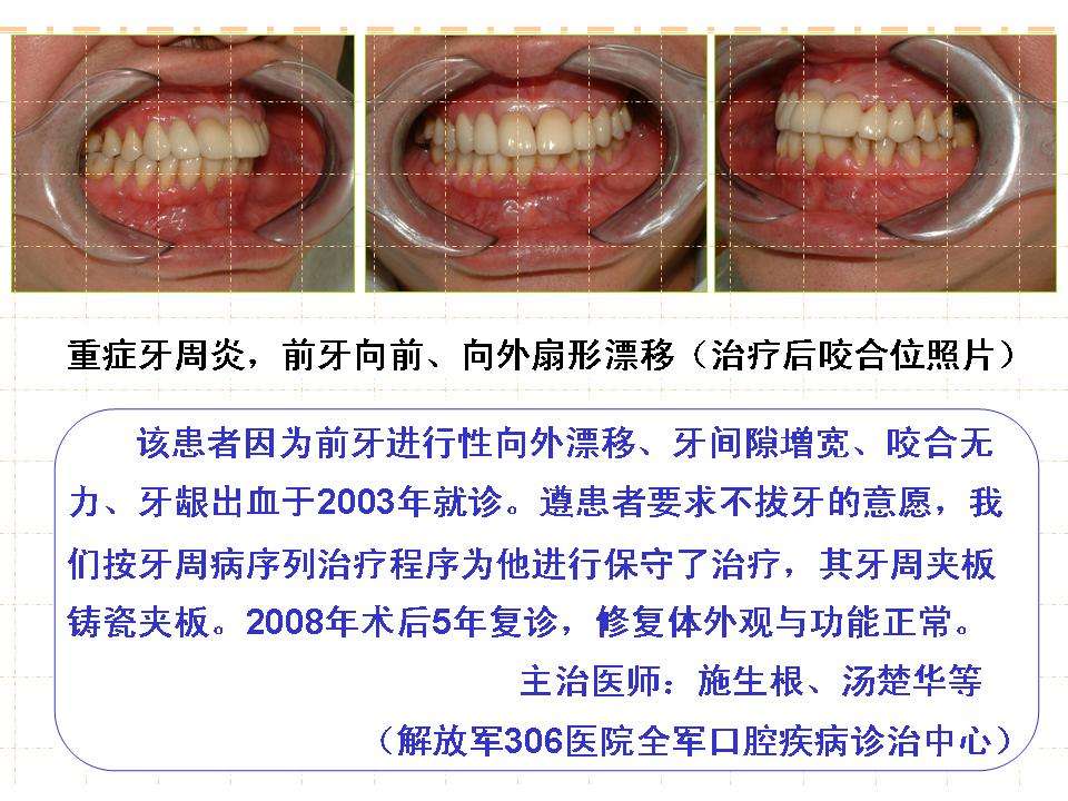 重症牙周炎,牙齿扇形漂移及其治疗