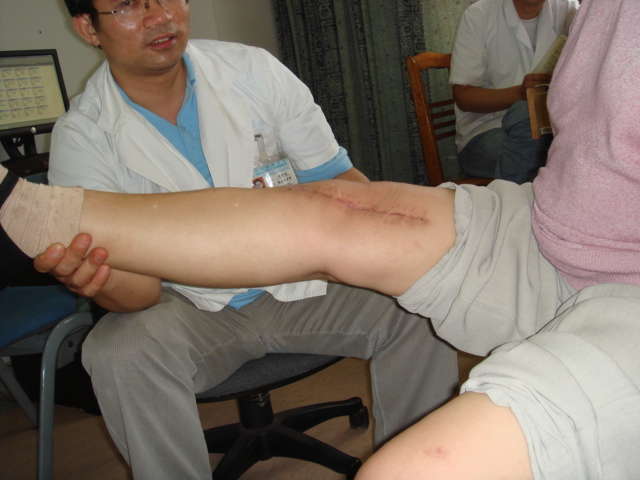 膝关节骨关节炎骨刺骨质增生的保健与治疗