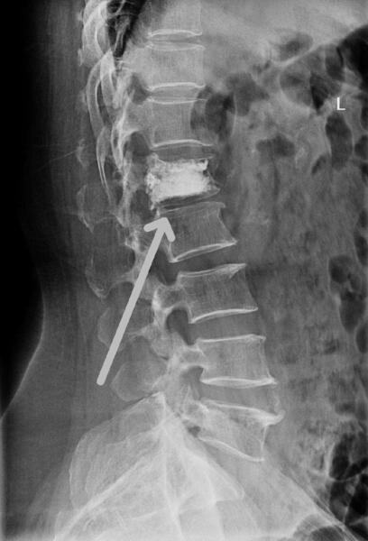 腰1椎体压缩性骨折行球囊扩张椎体成形术前,术后影像