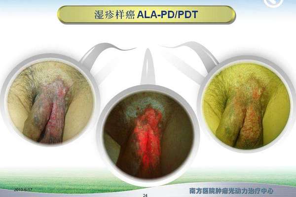 最新会阴湿疹样癌荧光诊断与光动力治疗典型病