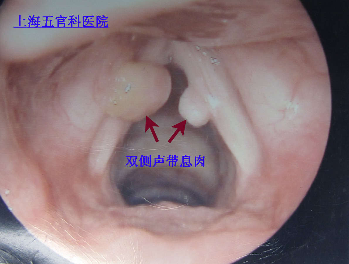 要手术治疗的声带息肉图片