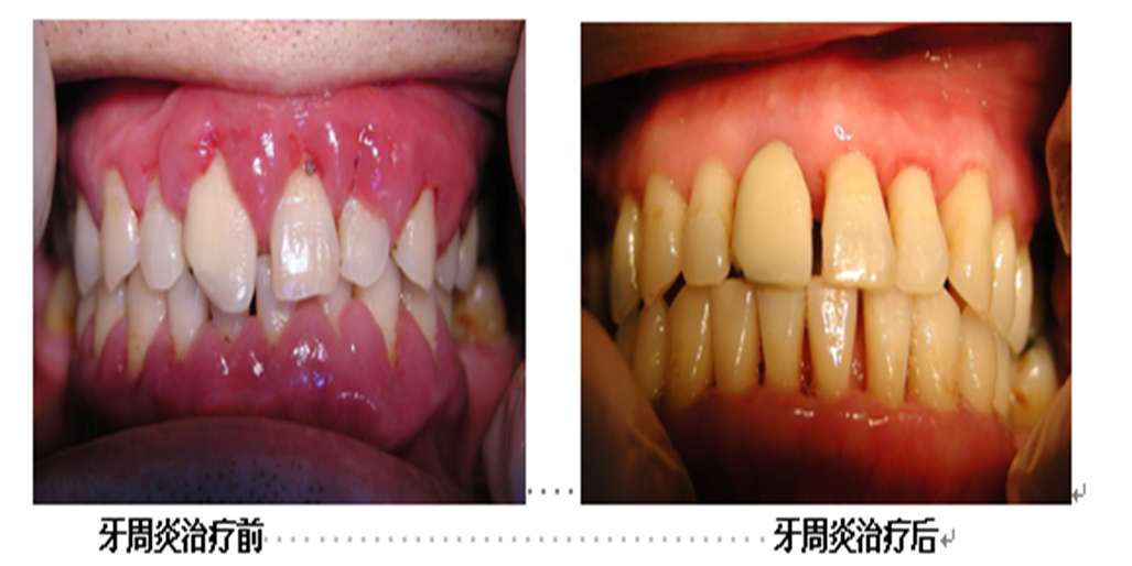牙周炎治疗前后比较