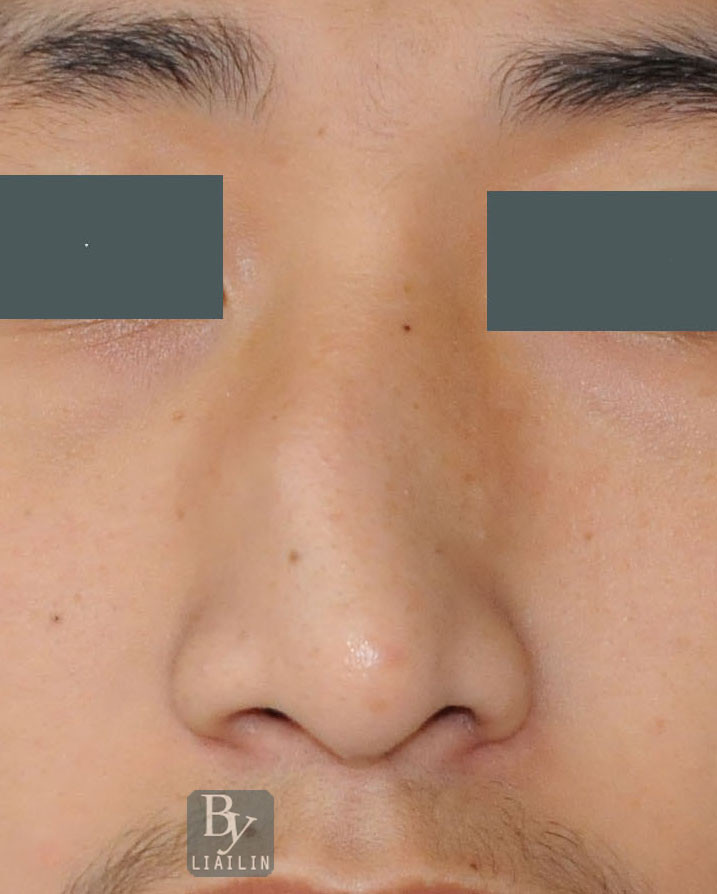 歪鼻的整形治疗    歪鼻一般由骨性和软骨性组成,也就是一般来说,鼻子