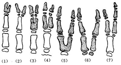 多指畸形概述(大量手术实例!