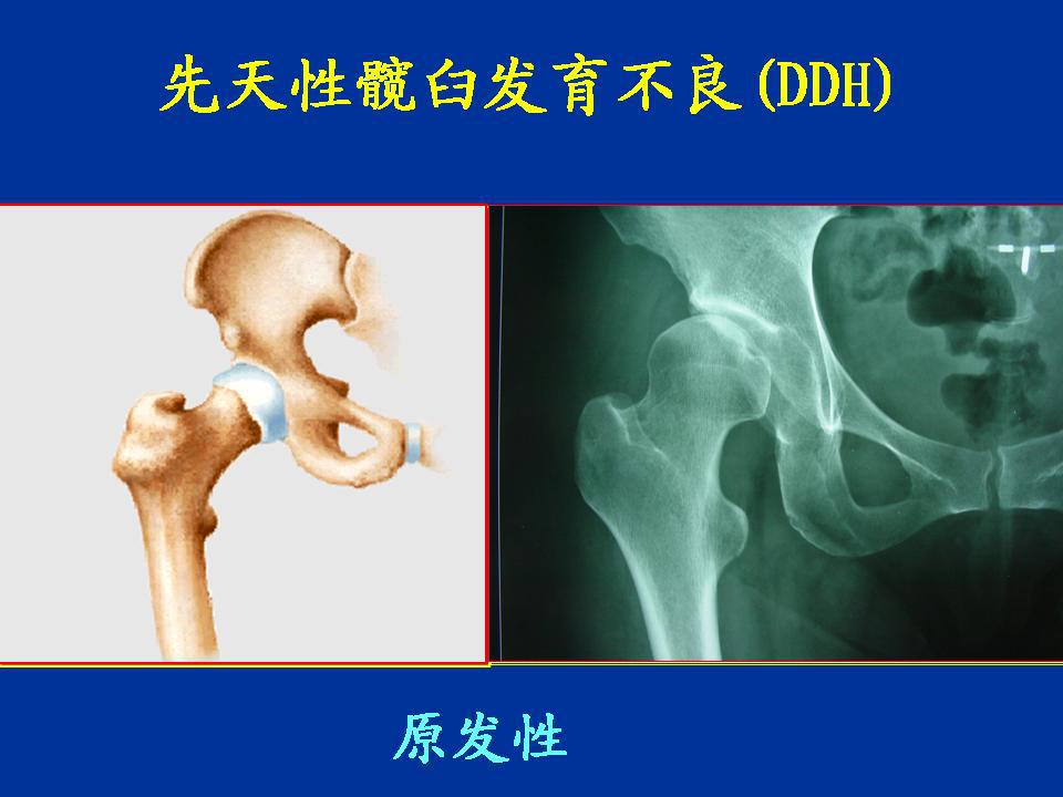 髋臼发育不良图片文章(上)