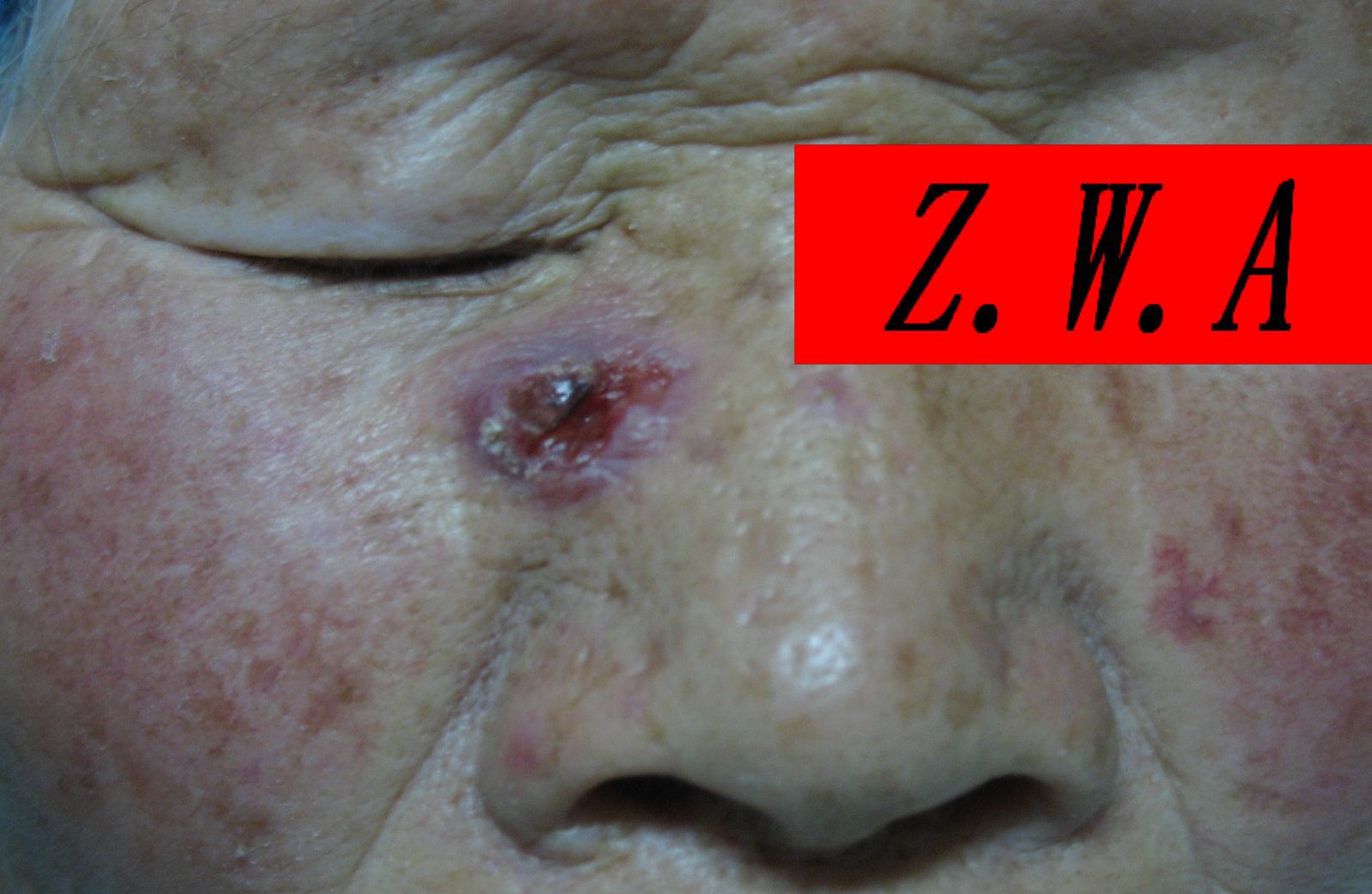 体表恶性肿瘤面部基底细胞癌鳞状上皮癌黑痣恶变的手术治疗图片