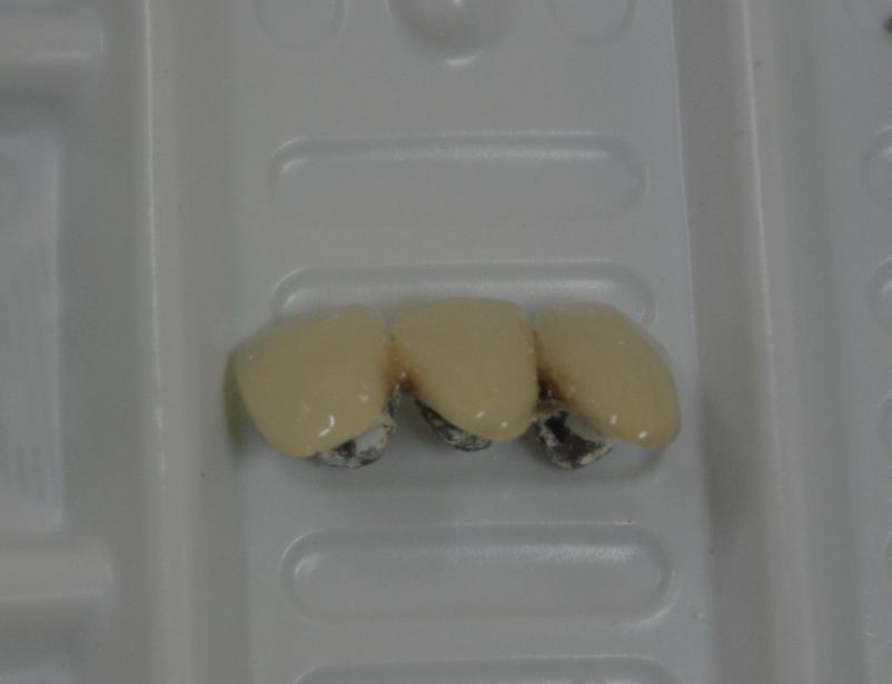 前牙美容修复病例3(贵金属烤瓷全冠修复1例)