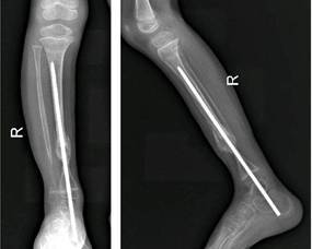 术后3月,右胫骨正侧位x线片:环形外固定装置未拆除,胫骨假关节处可见