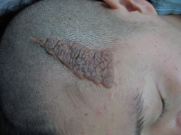头皮皮脂腺痣的手术治疗