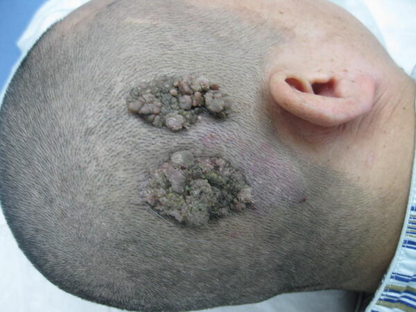 头皮皮脂腺痣的手术治疗2