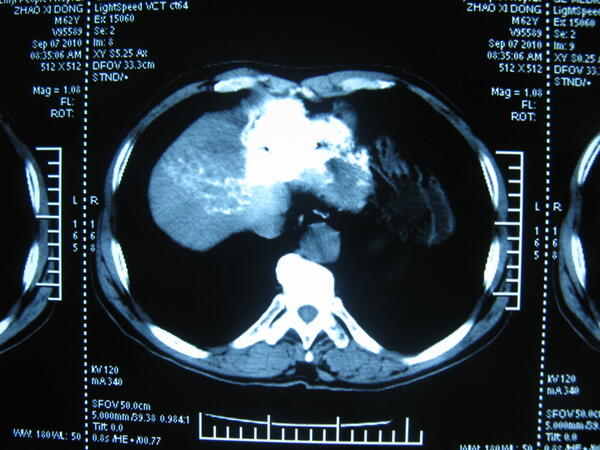 肝血管瘤的微创介入治疗
