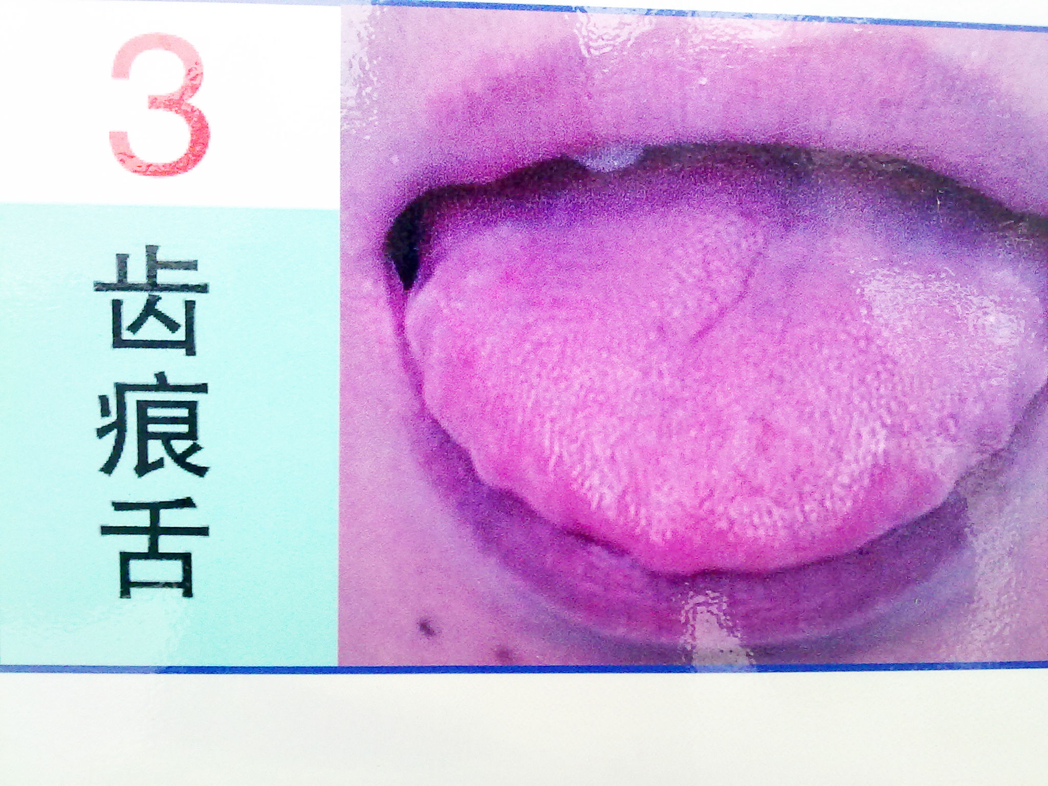 舌部表面病变的表现一(图)