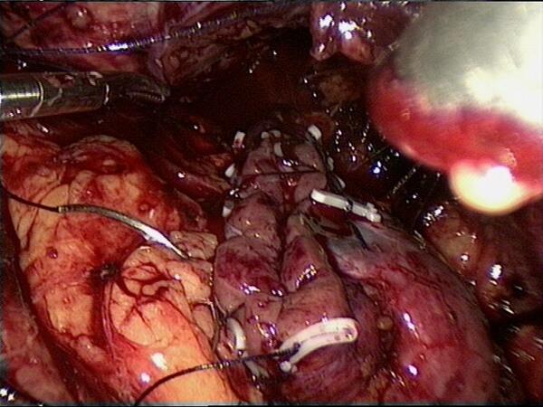 高难度手术荟萃23-大肾癌-腹腔镜肾部分切除术
