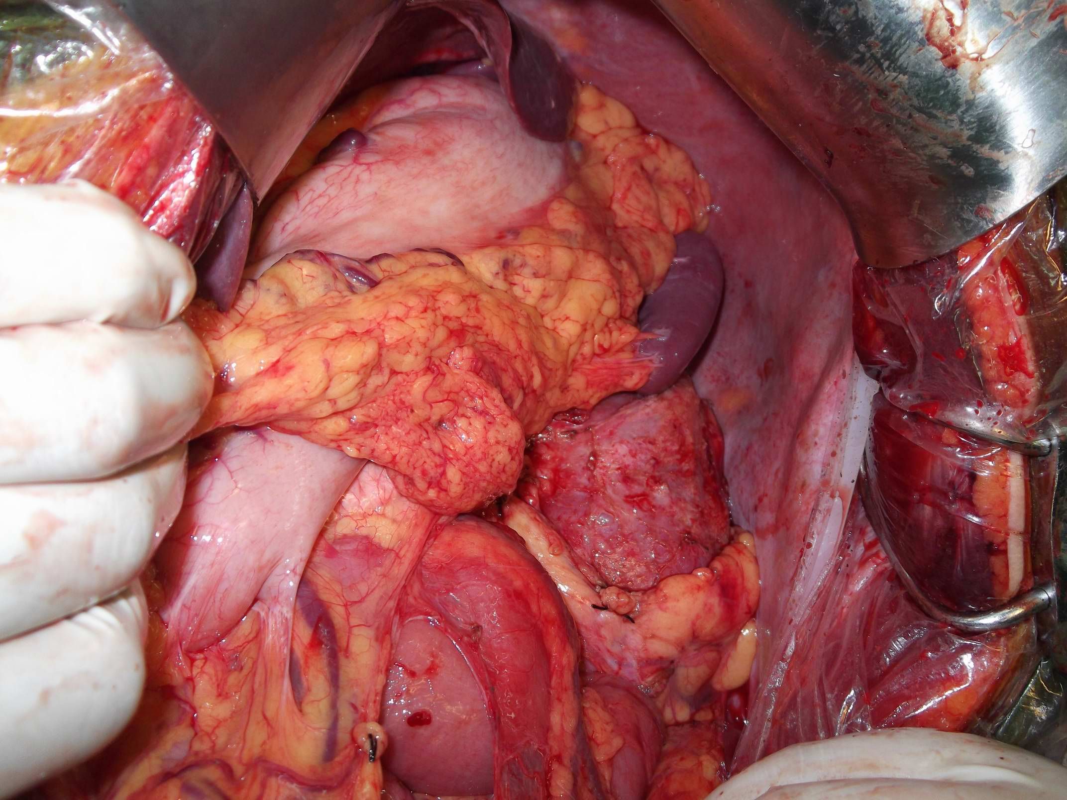腹膜后肉瘤