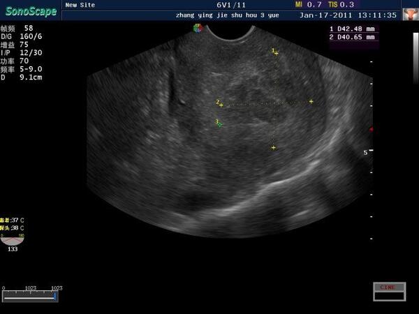 子宫肌瘤超声消融治疗效果图三
