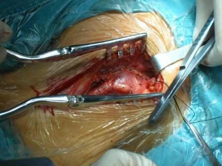 shamblin三级颈动脉体瘤的手术切除