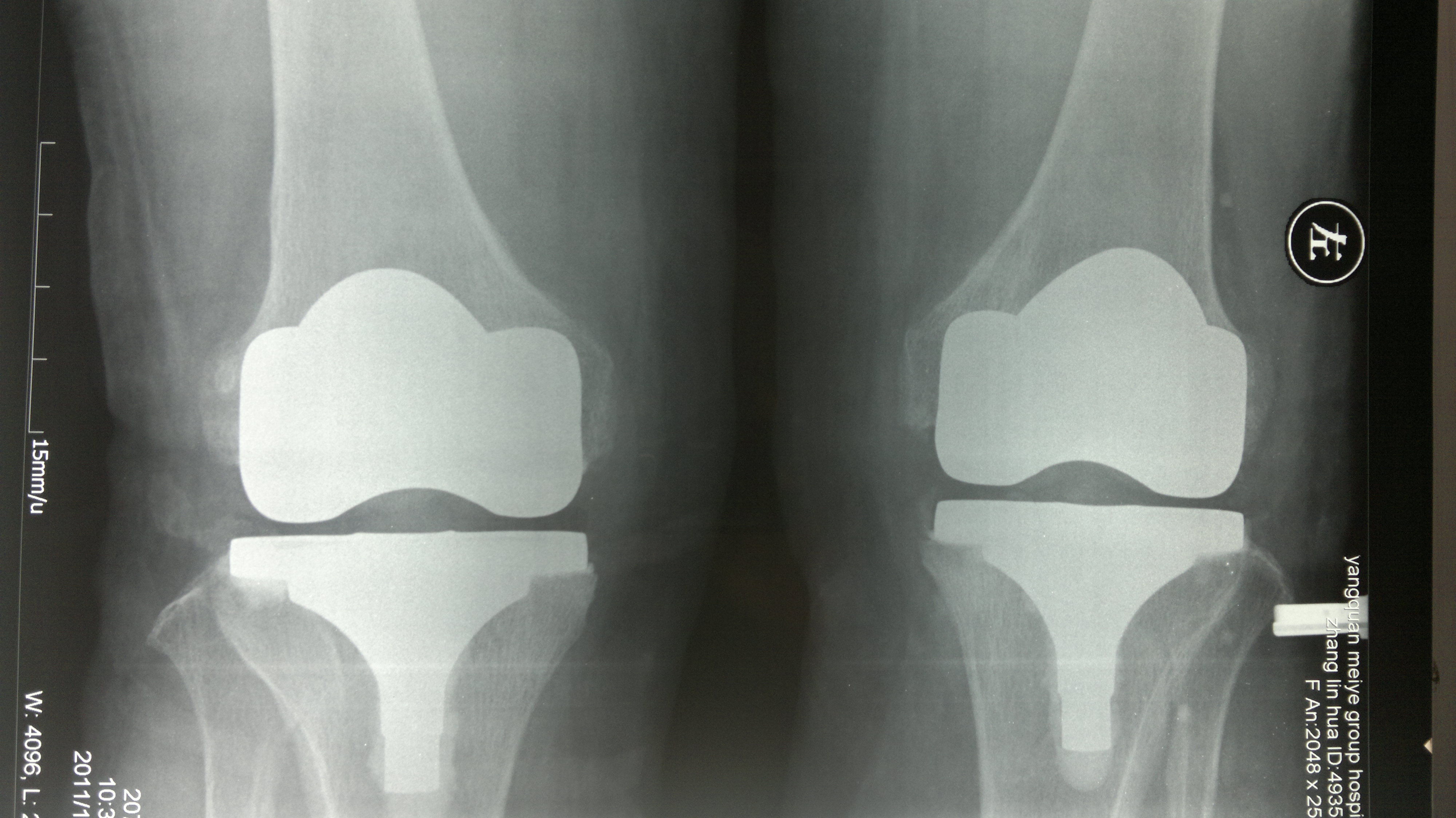(一期双侧膝关节同时置换术后正位片)