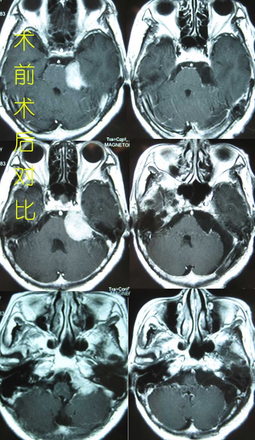 警惕致命的颅内良性肿瘤岩斜区脑膜瘤