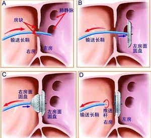 房缺封堵术_房间隔缺损_手术