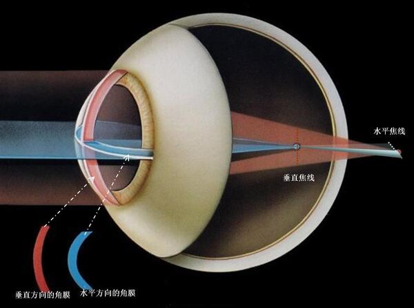 散光是指眼睛在不同的子午线具有不同的屈光力,也即眼睛屈光系统的