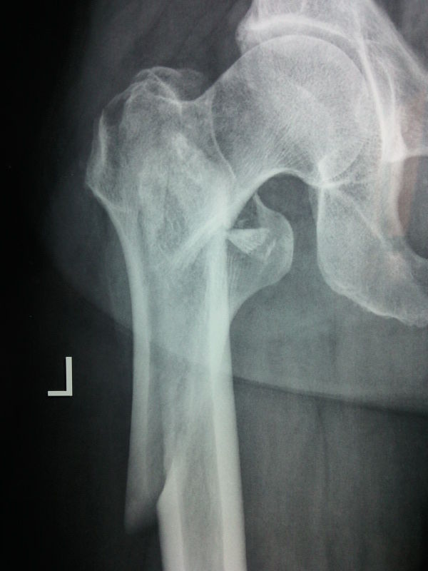 图片股骨近端骨折的手术治疗