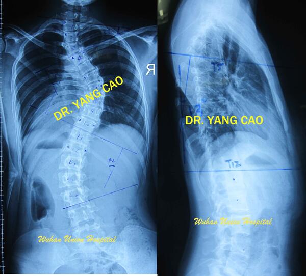 脊柱侧弯典型病例(4)