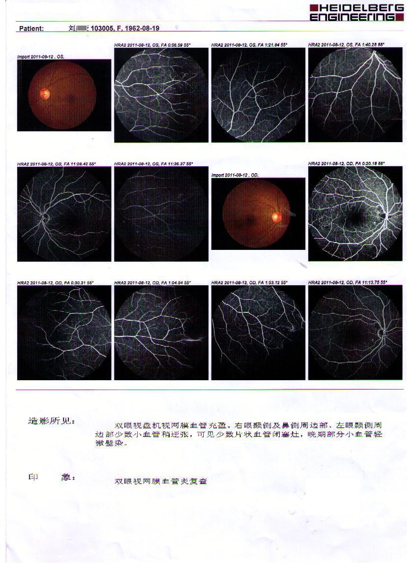 霜枝样视网膜血管炎 典型病例 眼底荧光造影