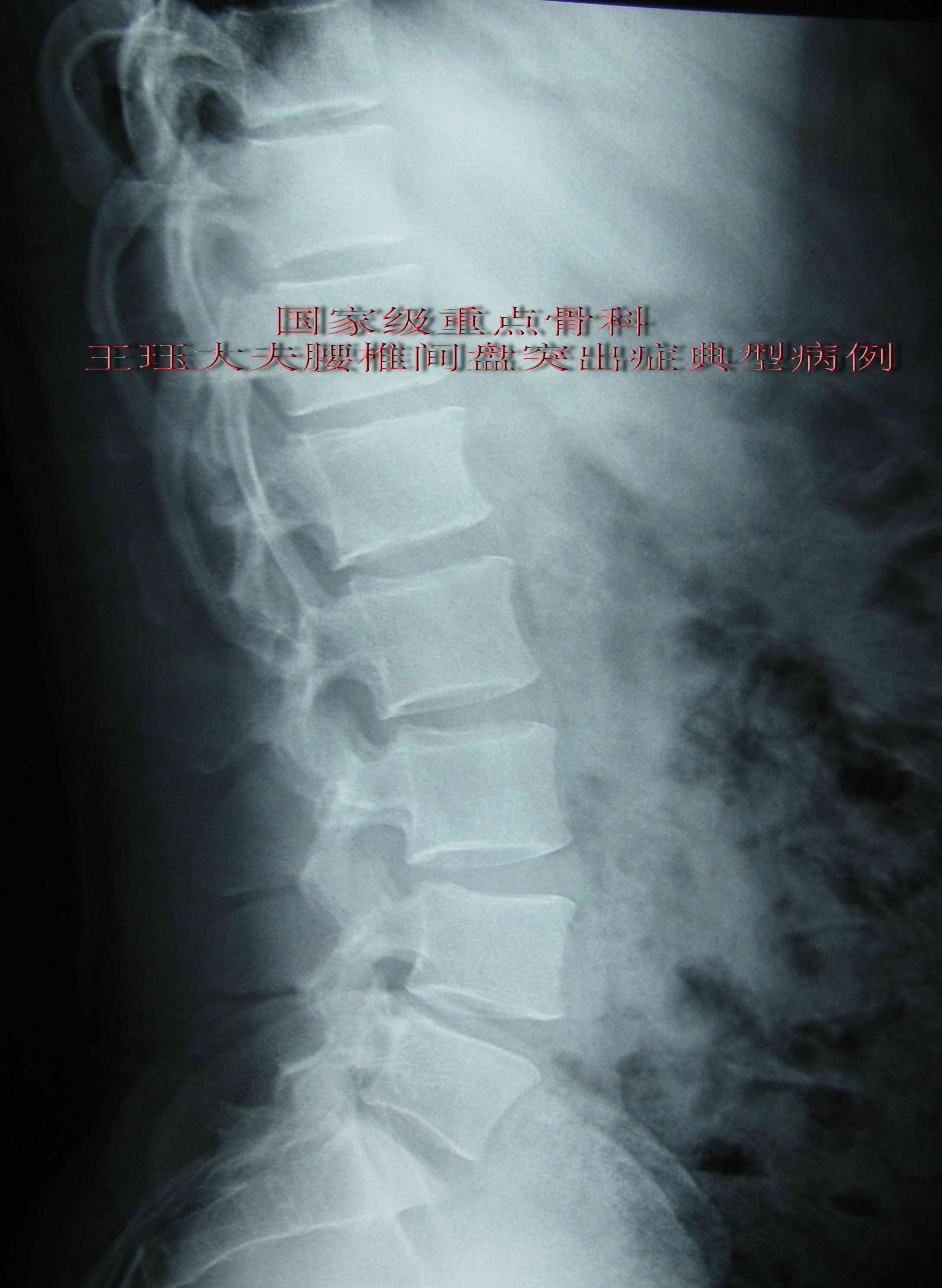 病例17:男,24岁,青年腰椎间盘突出症常见类型-椎体后缘离断症