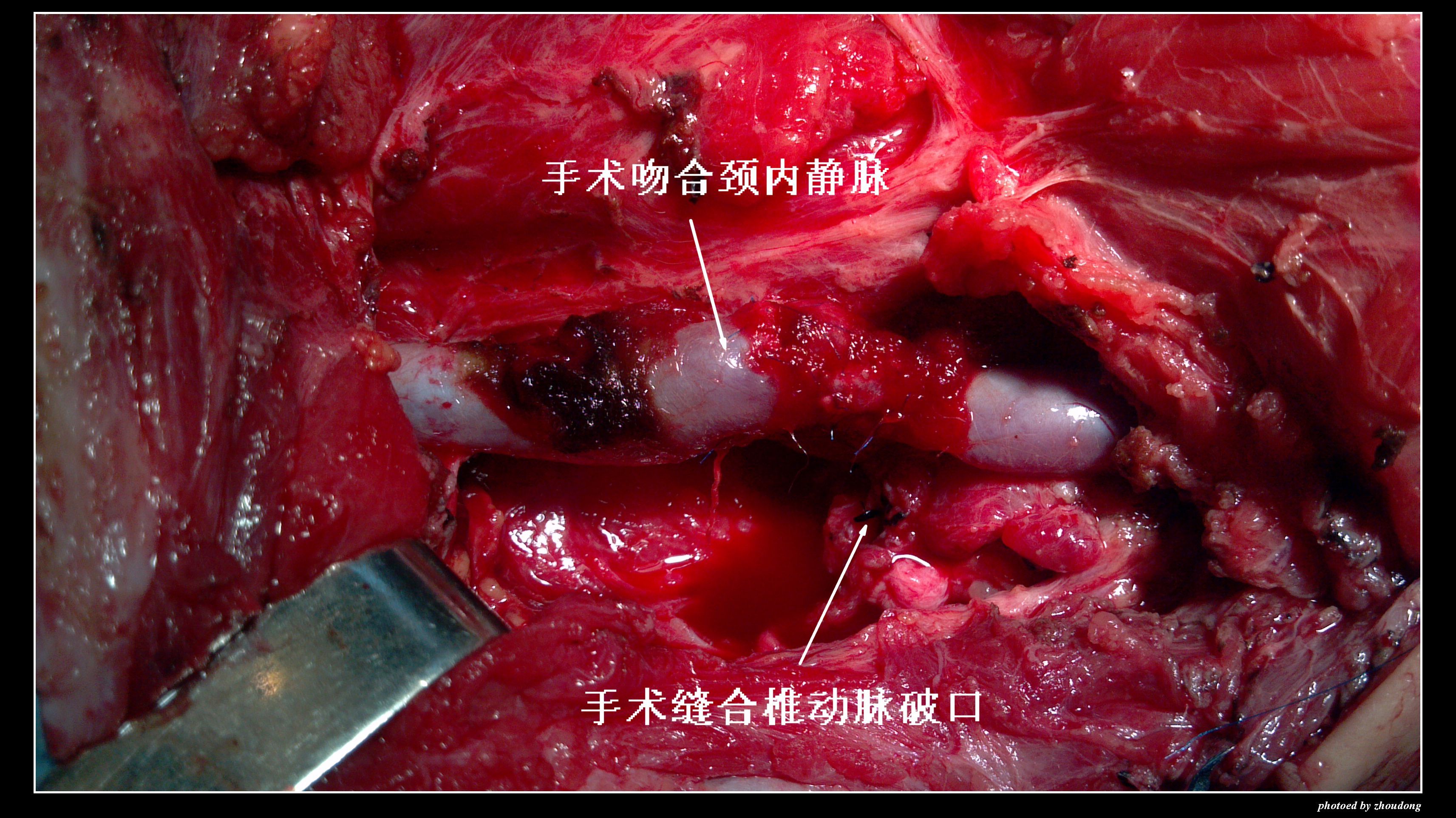 为生命搭建绿色通道---记兰大二院血管外科抢救颈部刀刺伤并大出血