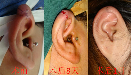 耳部瘢痕疙瘩治疗