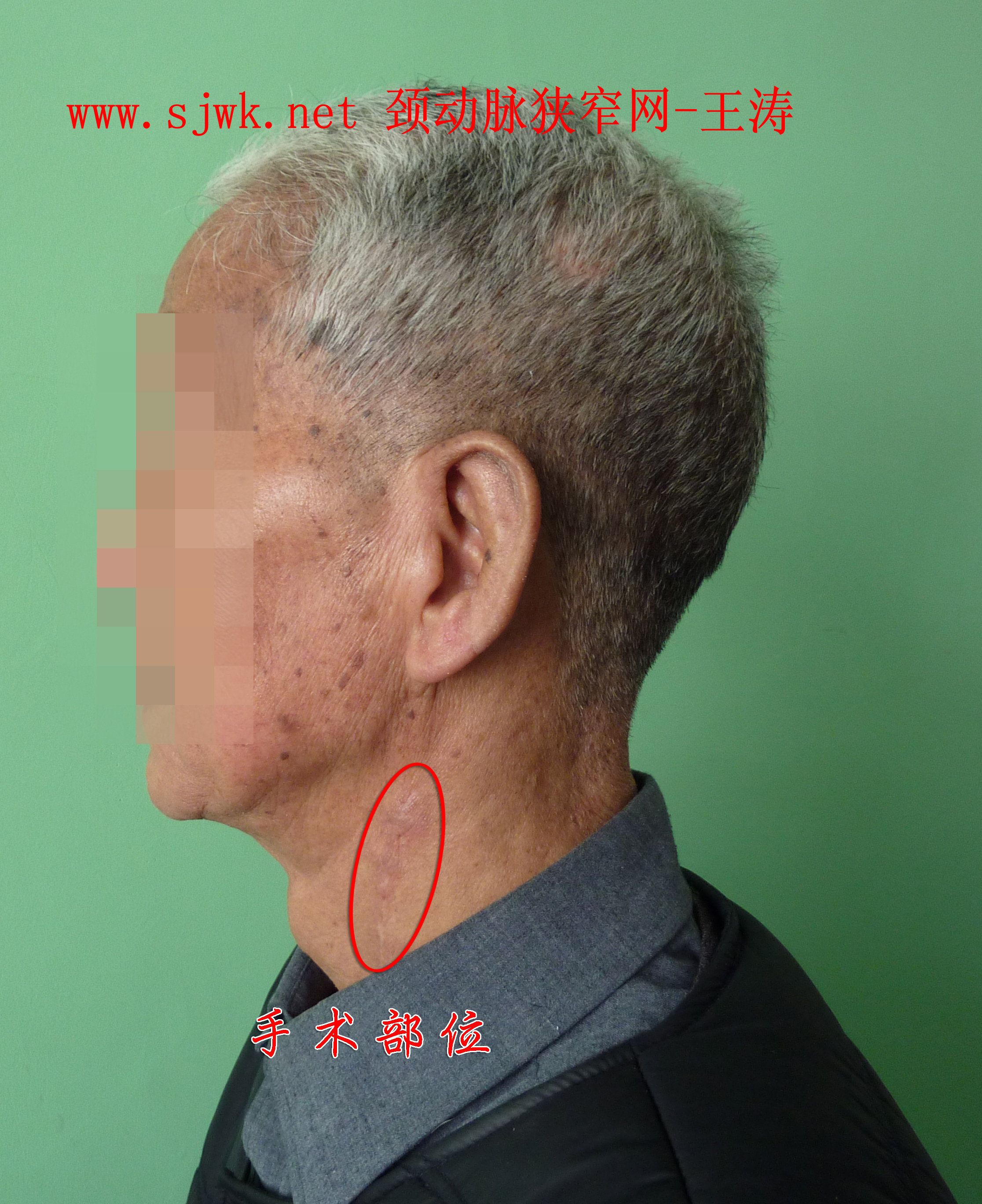 高龄患者87岁颈动脉内膜切除术前后