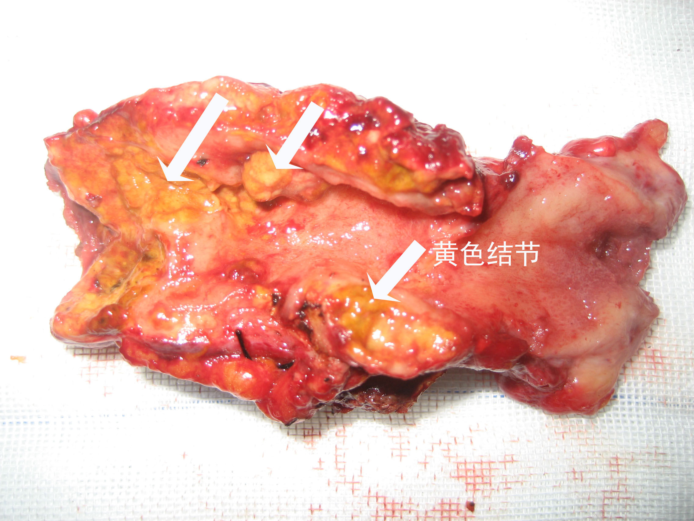 黄色肉芽肿性胆囊炎的诊断与治疗