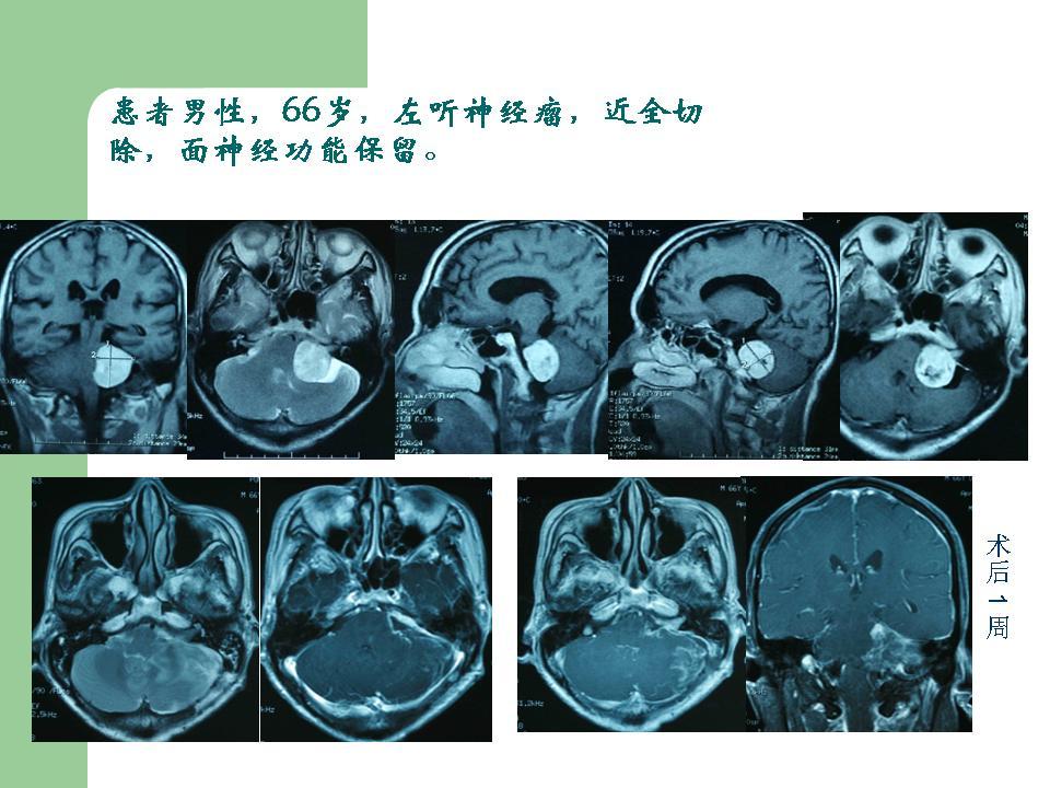 枕下乙状窦后入路切除听神经瘤