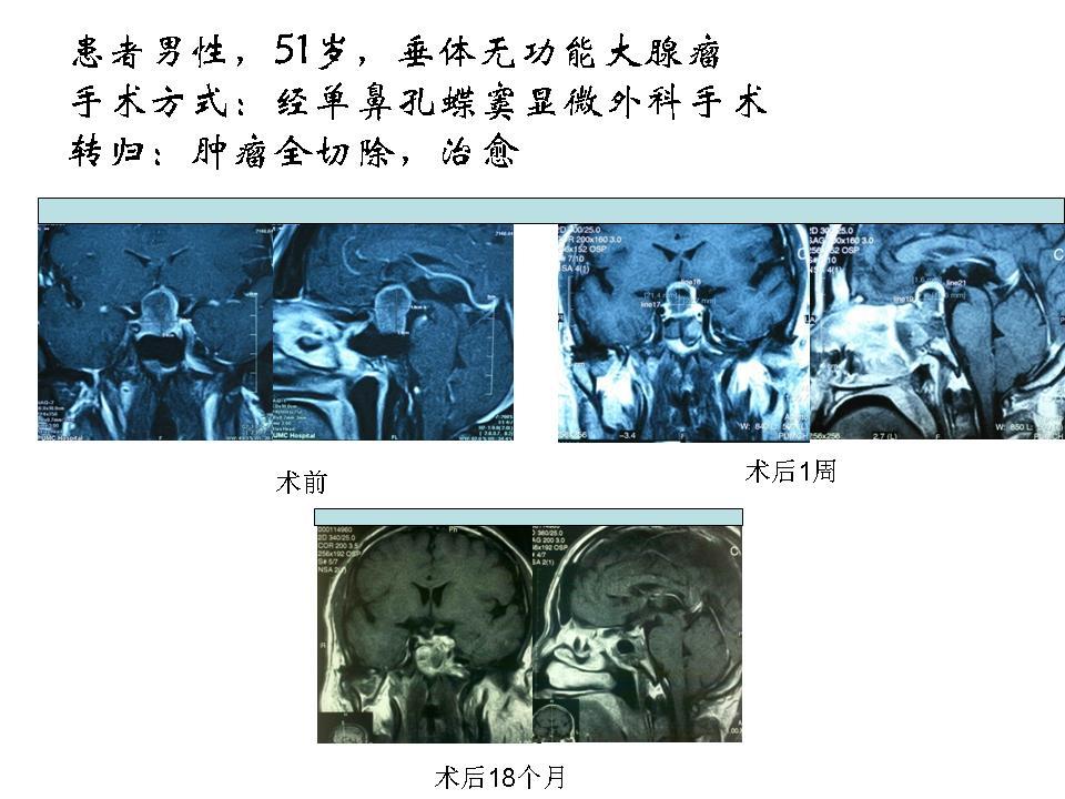 经单鼻孔蝶窦手术切除垂体无功能腺瘤