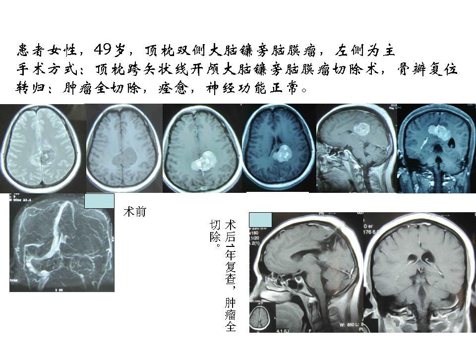 但仅从左侧纵裂进入,切除向双侧发展的肿瘤,也顺利做到肿瘤全切除