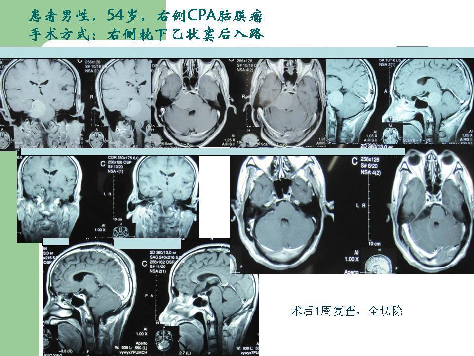 枕下乙状窦后入路切除桥脑小脑角脑膜瘤