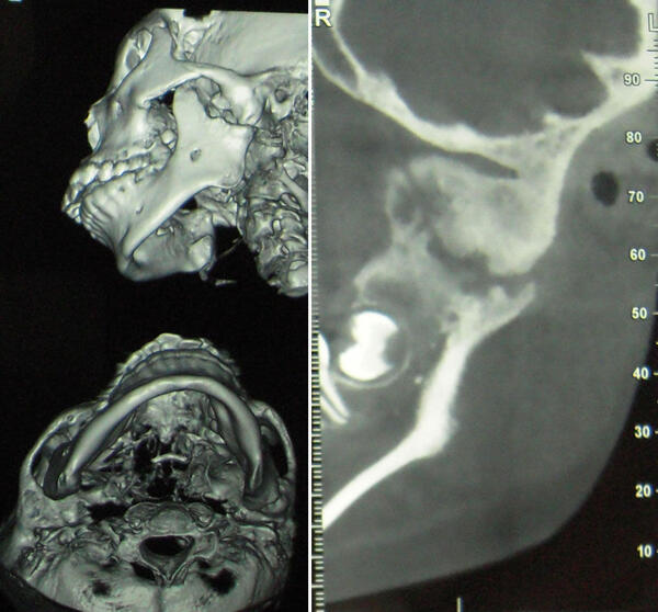 颞下颌髁突骨折术后发生关节强直,喙突移植重建髁突(有图片)