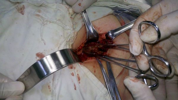 昨晚做的一例阑尾炎手术(附图片) - 好大夫在线