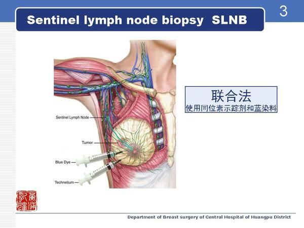 图解乳腺癌前哨淋巴结活检术